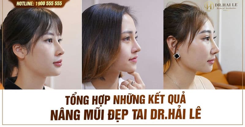 Tổng hợp những kết quả nâng mũi đẹp tai Dr.Hải Lê