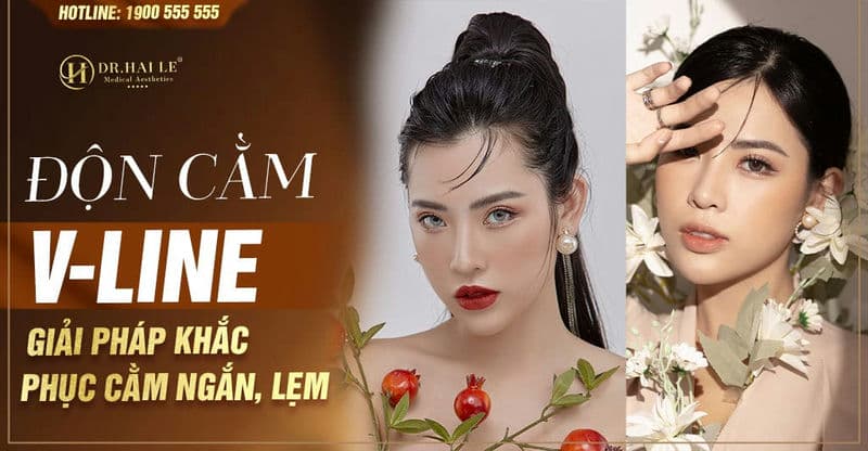 Độn cằm V-line - Giải pháp khắc phục cằm ngắn, lẹm