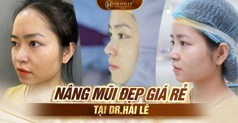 Nâng Mũi Đẹp Giá Rẻ