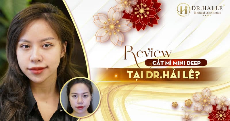 Review cắt mí Mini Deep tại Dr.Hải Lê