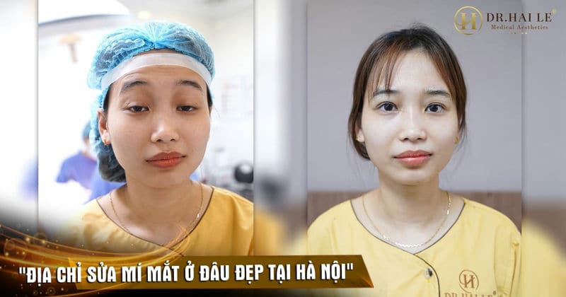 Top 3 địa chỉ sửa mí mắt ở đâu đẹp tại Hà Nội