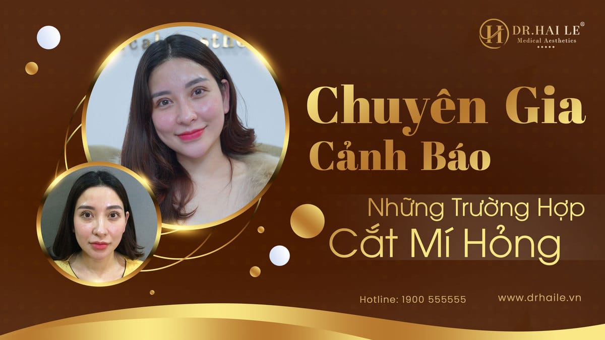 Chuyên gia cảnh báo những trường hợp cắt mí hỏng