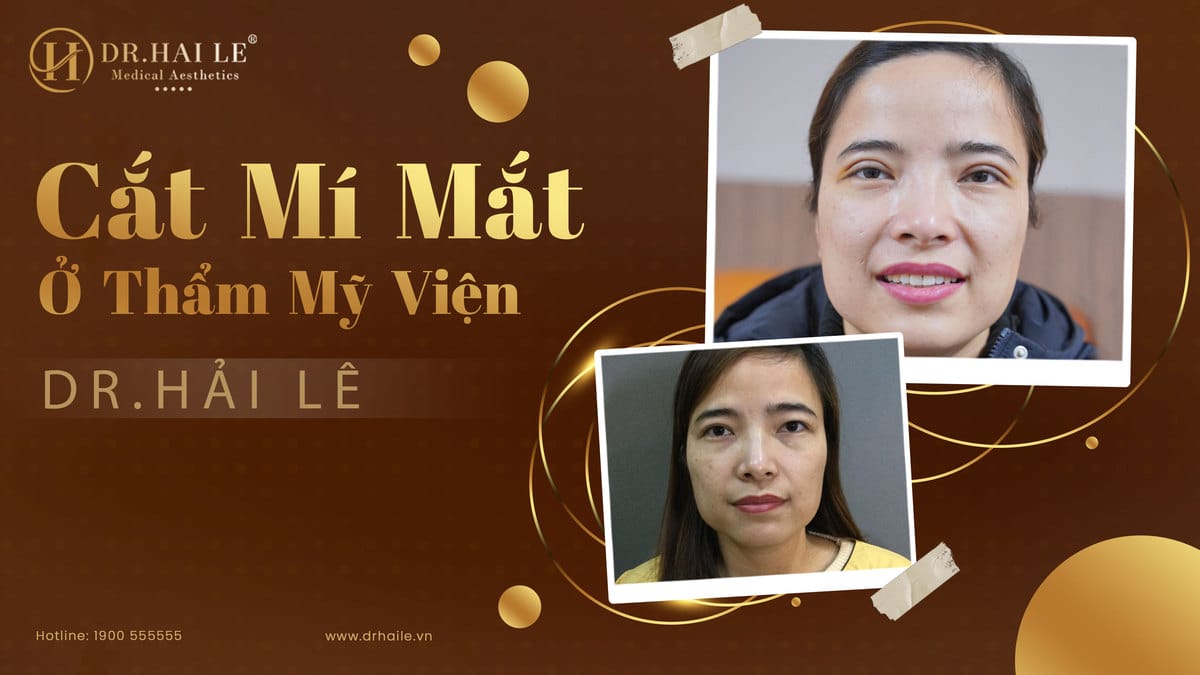 Cắt mí mắt ở thẩm mỹ viện Dr.Hải Lê