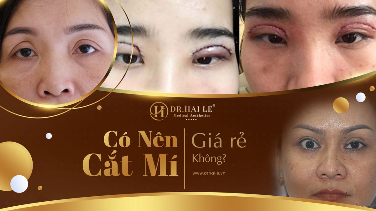 Có nên cắt mí giá rẻ không?