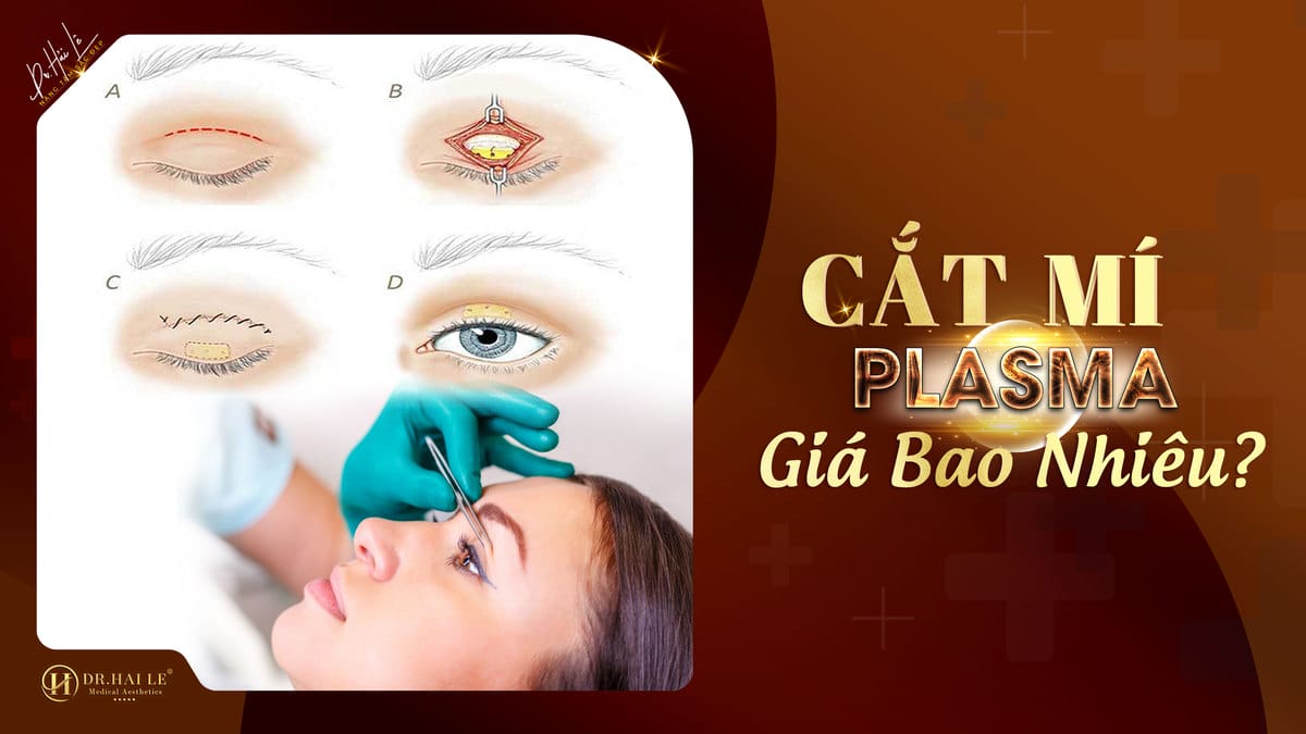Cắt mí plasma giá bao nhiêu?
