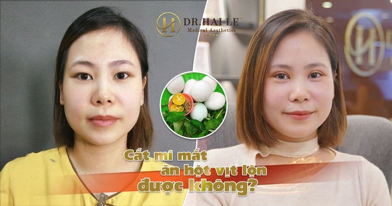 Cắt mí mắt ăn hột vịt lộn được không?
