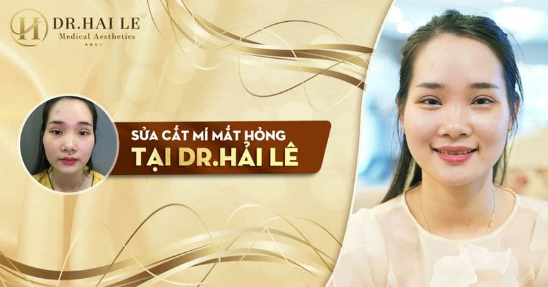 Phục Hồi Vẻ Đẹp Tự Nhiên với sửa mí mắt thẩm mỹ tại Dr.Hải Lê