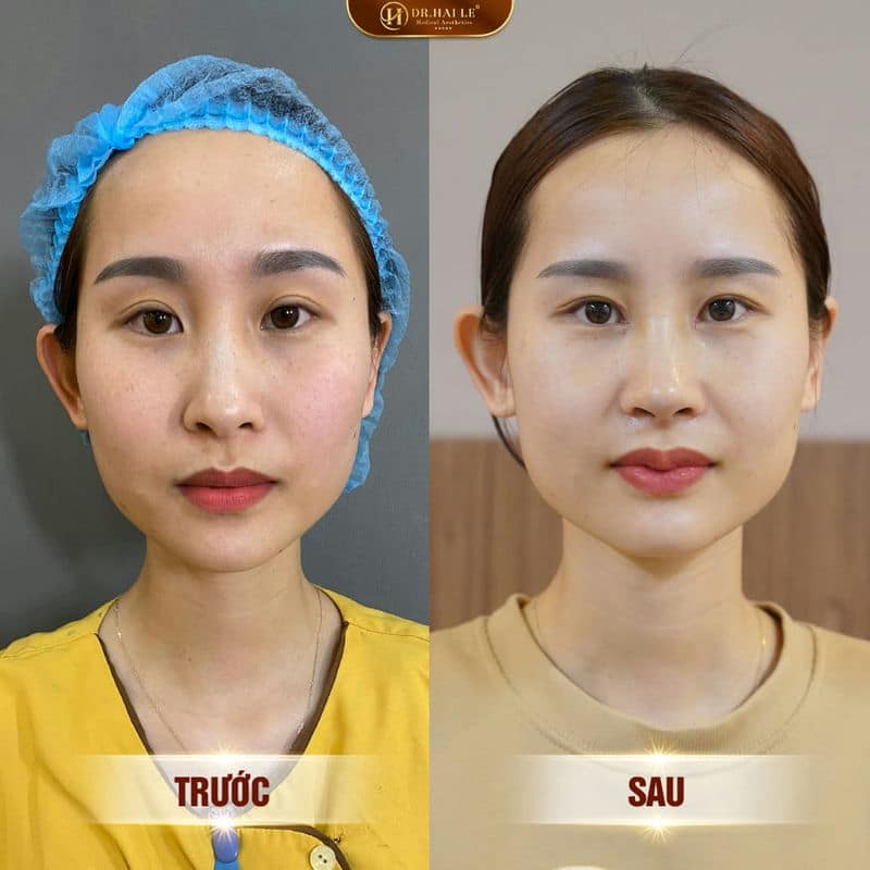 Ảnh trước sau