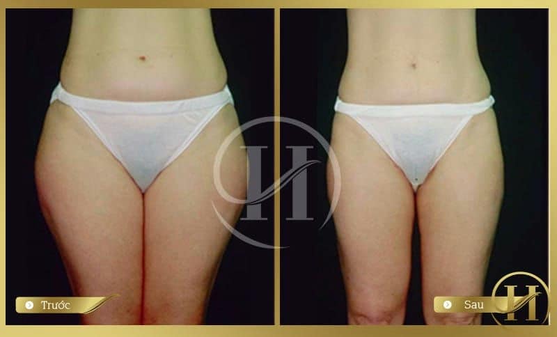Sự khác biệt trước và sau khi giảm mỡ đùi tại Dr.Hải Lê
