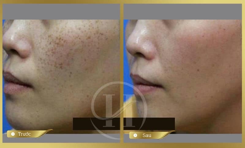 Kết quả trước và sau khi trị nám da bằng Laser Spectra tại Dr.Hải Lê