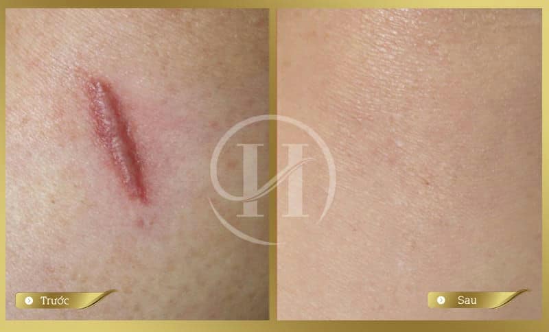 Ảnh trước sau  
