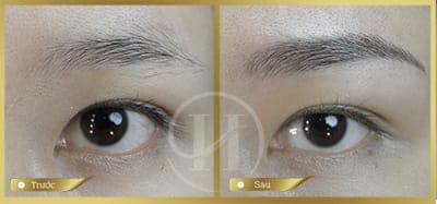 Ảnh trước sau  