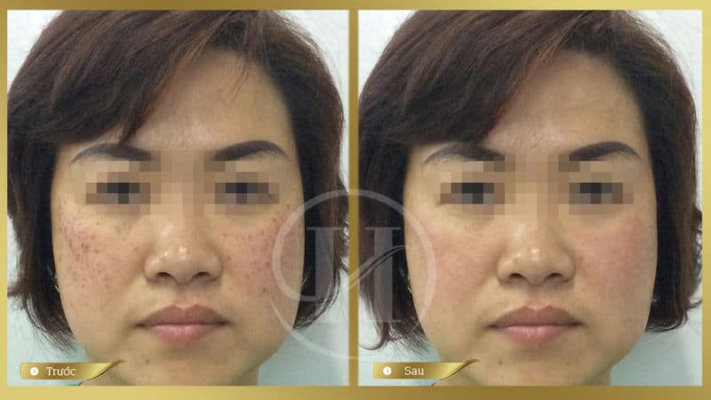Hiệu quả trước và sau khi trị nám bằng Laser Spectra tại Dr.Hải Lê