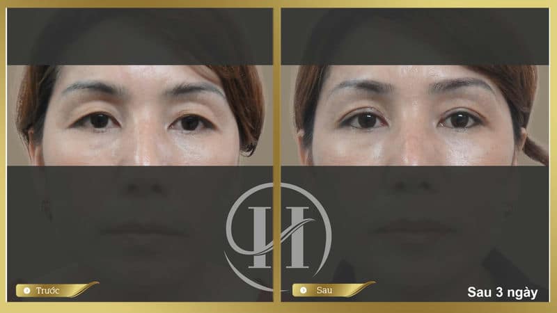 Hiệu quả trước và sau khi nhấn mí