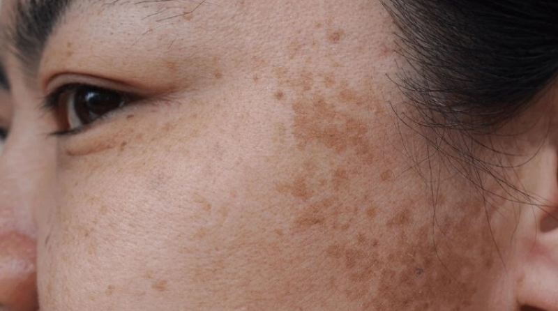 Retinol Trị Nám: Bí Mật Cho Làn Da Rạng Rỡ Retinol Trị Nám: Bí Mật Cho Làn Da Rạng Rỡ