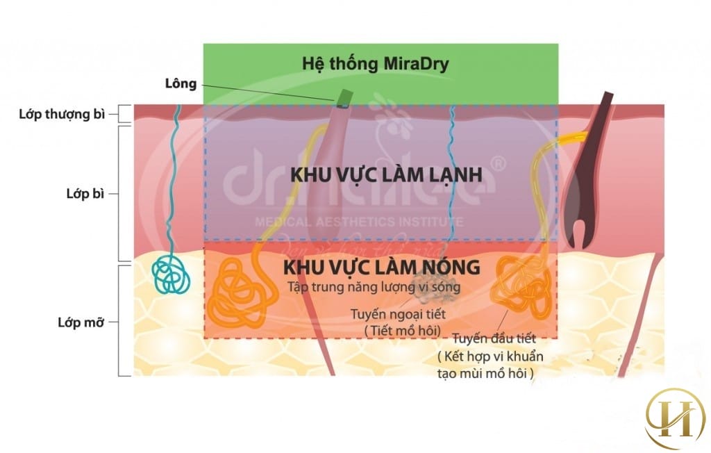 trị hôi nách bằng miradry