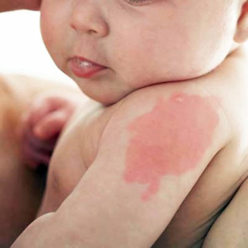 Chàm bớt ở vị trí bắp tay