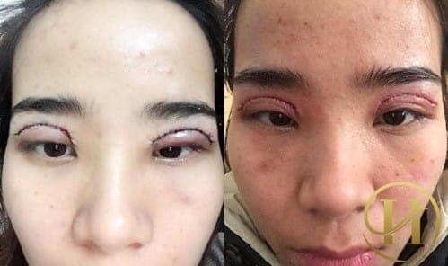 cắt mí mắt giá rẻ, cắt mí giá rẻ, cắt mắt 2 mí giá rẻ