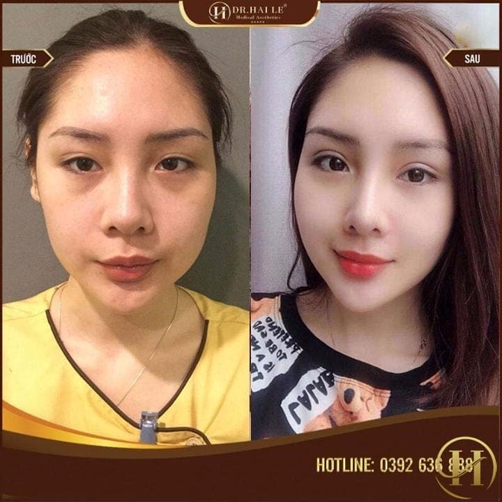 Kết quả cắt mí HL