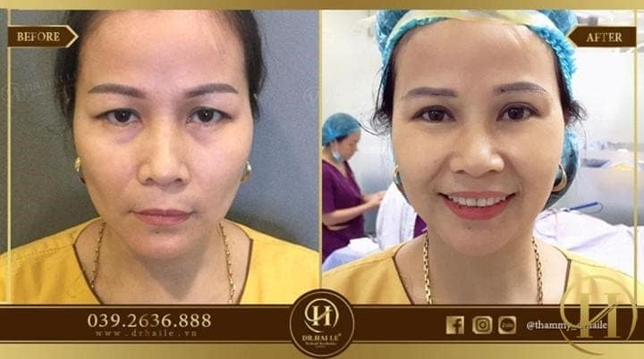 Kết quá nâng cung mày HL