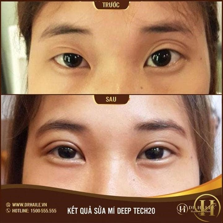 Kết quả sửa mí HL