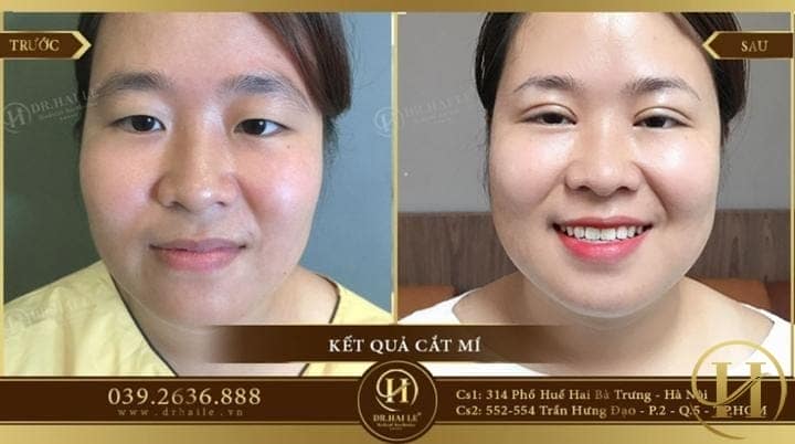 Kết quả cắt mí của Thanh Bình