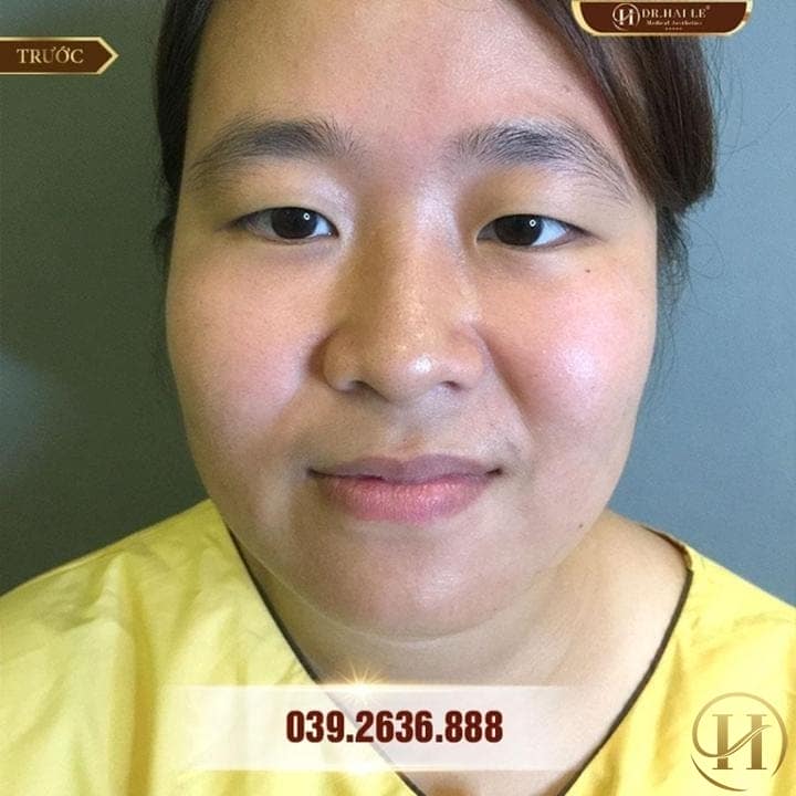 Khách hàng Thanh Bình mắt 1mis