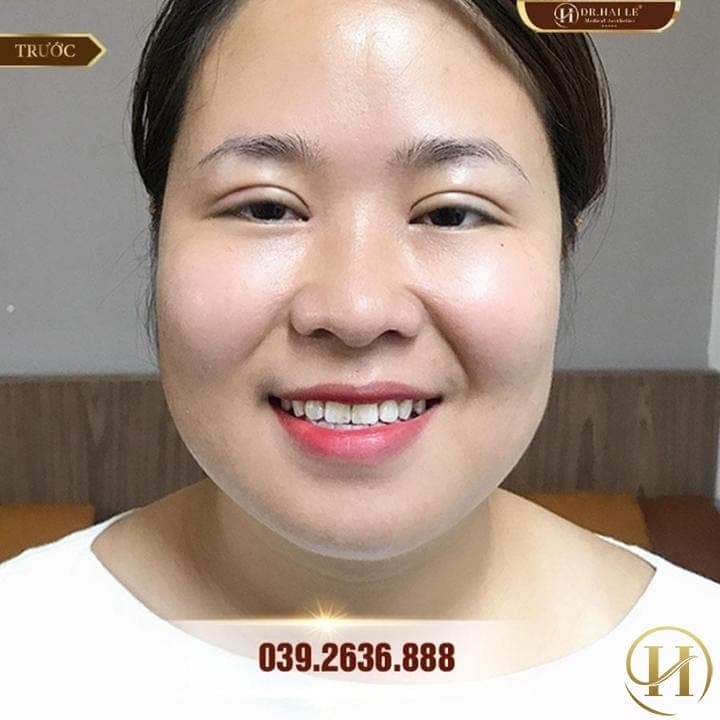 Thanh Bình sở hữu mắt 2 mí