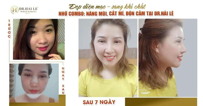 Thay đổi diện mạo với combo nâng mũi, cắt mí, độn cằm tại Dr.Hải Lê