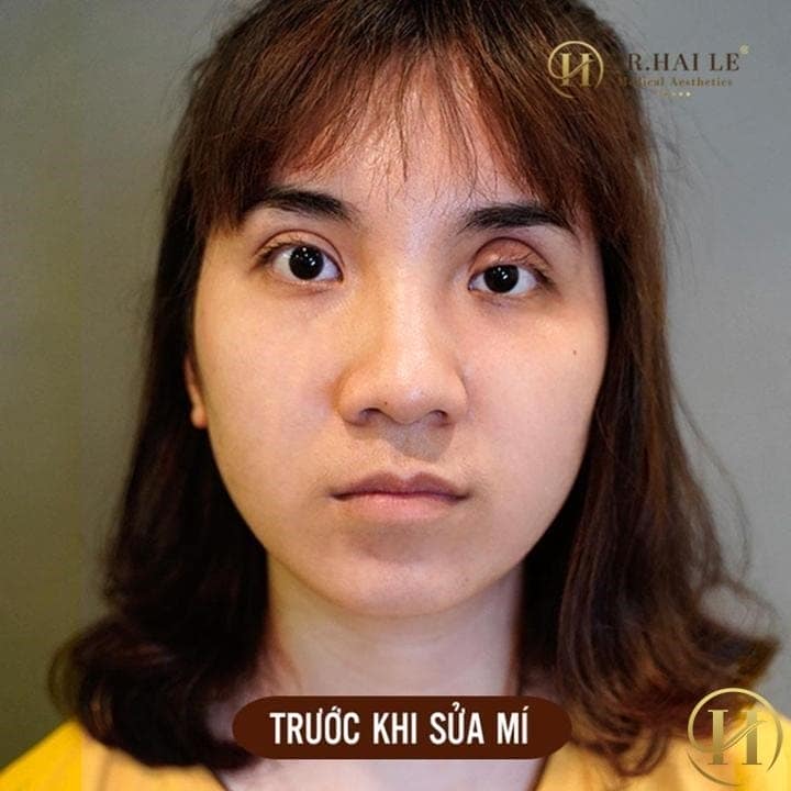 Mắt bị “biến chứng” nặng