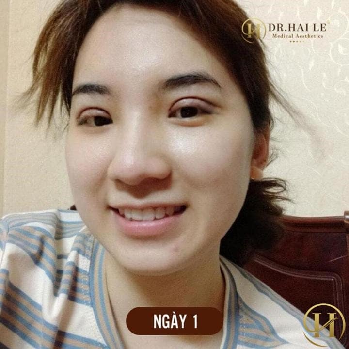1 ngày sau khi cắt mí: ôi nó sưng tấy, nhưng không hề đau