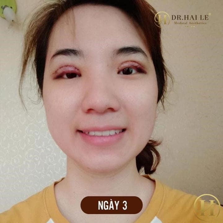 3 ngày sau sửa mí: nó đỡ sưng dần nhưng kiểu bị lo lắng