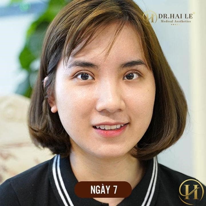 7 ngày sau sửa mí, mình rất hài lòng, ai cũng khen ạ!