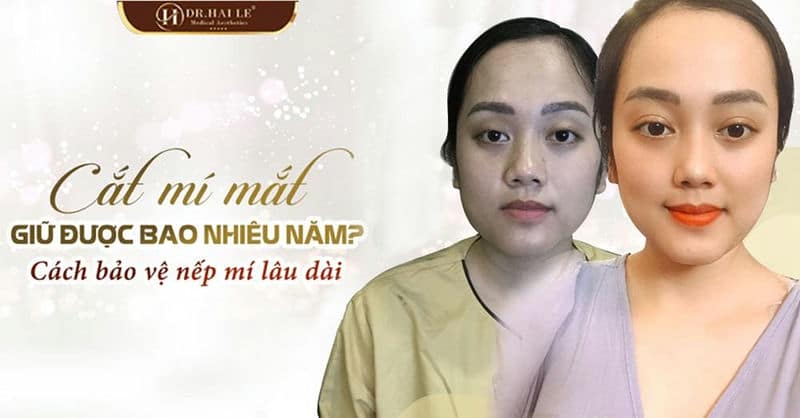 Cắt mí mắt giữ được bao nhiêu năm? Cách bảo vệ nếp mí lâu dài?