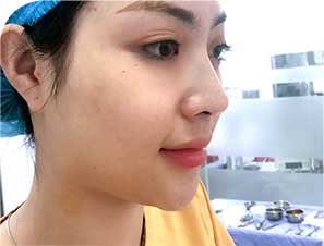 Nâng mũi Medi-Form