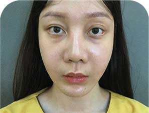 Sửa mí dưới Deep Tech Repair