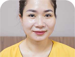 Cắt mí Mani Mini Deep 5D