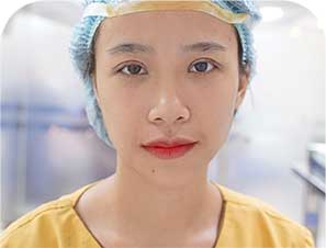 Cắt mí Mani Open Deep 5D