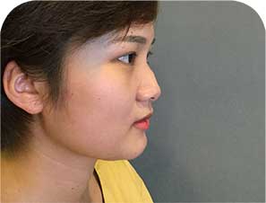 Phẫu thuật sửa mũi gồ