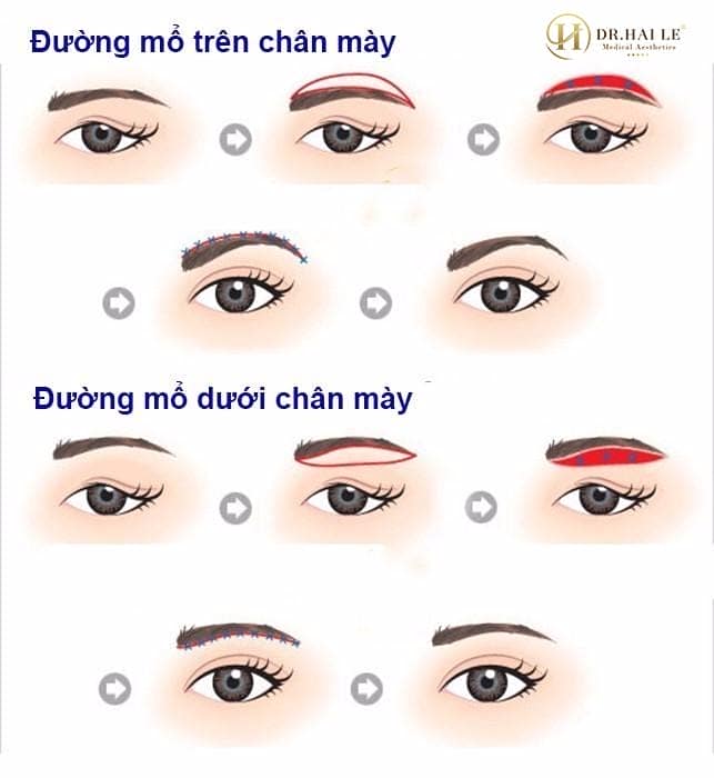 NÂNG CUNG MÀY VÀ NHỮNG ĐIỀU CẦN BIẾT