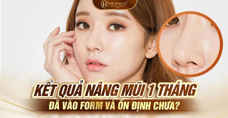 Nâng mũi 1 tháng đã ổn định chưa? Cần lưu ý gì sau khi nâng mũi?