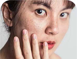 Công nghệ trị tàn nhang