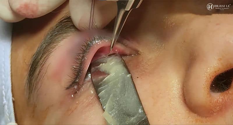 Rùng rợn giải cứu: "Mí nhiễm mưng mủ, mắt tím thâm, tụ máu cho khách hàng làm đẹp tại cơ sở thiếu uy tín!"