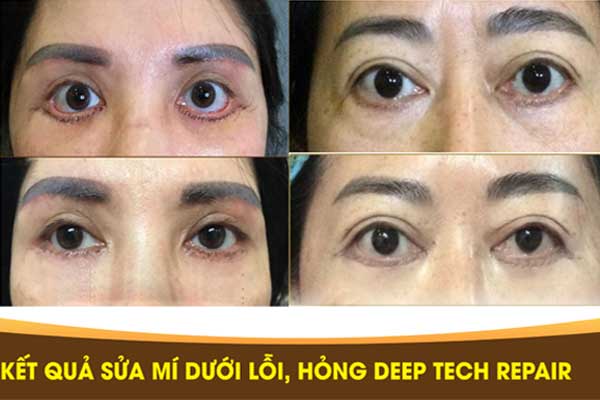 Sửa mí dưới Deep Tech Repair