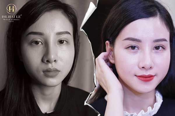 Sửa Mí Lỗi Hỏng Deep Tech