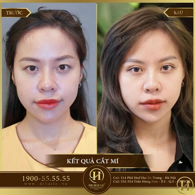Cắt mí Mani Open Deep 5D