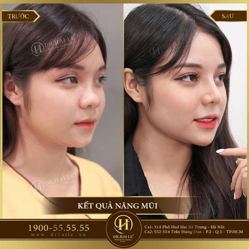 Nâng mũi Demi 5D
