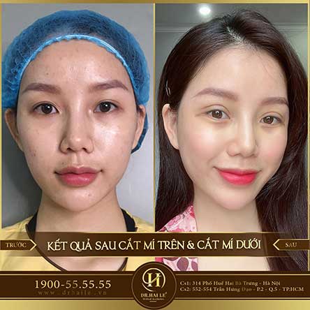 Cắt mí Mani Open Deep 5D