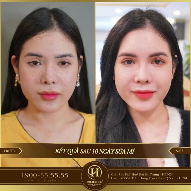 Sửa Mí Lỗi Hỏng Deep Tech20