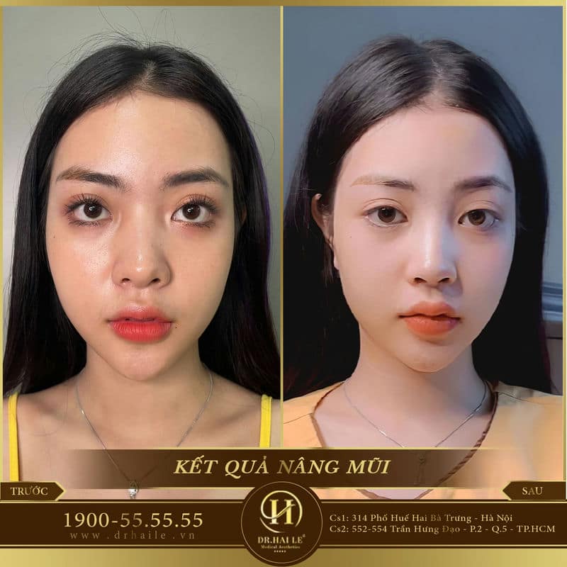 Nâng mũi Demi Tech 6D